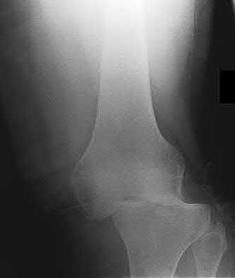 Illustration 162 for OrthoCash: Trauma MCQs & Cases for a yearold woman