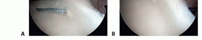 Illustration 27 for Regain Stability: Arthroscopy for Anterior Instability & the Inferior Glenohumeral Ligament