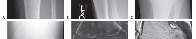 Illustration 15 for Dissecans of the Knee: What's the Difference – OCD vs. AVN?