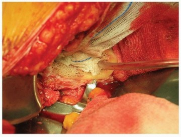 Illustration 26 for Why Polished Tapered Cemented Stems Excel in Hip Replacement