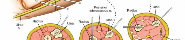 Illustration 7 for Key Approaches for External Fixation: Humerus, Radius, Ulna, Wrist