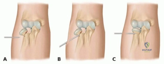 تعافى من أي حاله تسبب ألمًا! علاج إصابات الملاعب بمركز الهطيف صنعاء