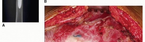 Illustration 32 for Allograft Prosthetic Composite: Mastering Proximal Femur Reconstruction