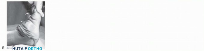 Illustration 6 for Expert Guide to Triple Arthrodesis et al. for Hindfoot