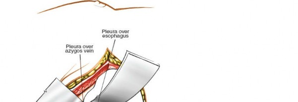 Illustration 321 for Approach to the Lumbar Spine: Mastering Techniques & Anatomy