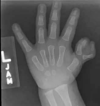 ازدواج إبهام اليد من النوع الرابع (Wassel Type IV): دليل شامل للآباء والعائلات في اليمن