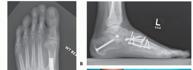 Illustration 82 for Mastering Midfoot Arthrodesis: Protect the Deep Neurovascular Bundle