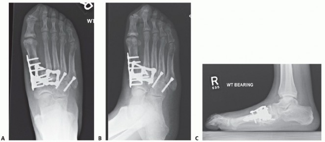 Illustration 55 for Mastering Midfoot Arthrodesis: Protect the Deep Neurovascular Bundle