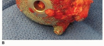 Illustration 10 for Uncemented Acetabular Revision: Optimizing Hemispherical Cup Use