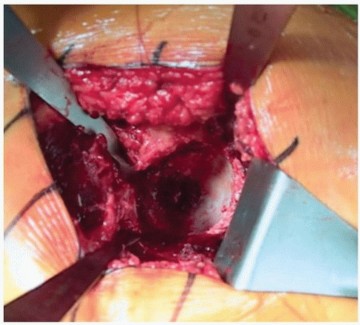 Illustration 8 for Unlock Precision: The Direct Lateral Approach for THA