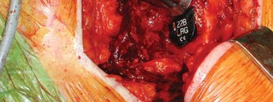 Illustration 23 for S-ROM: Inside the Technique of Modular Implant Design