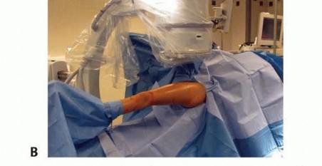 Illustration 8 for Pediatric Femoral Nailing: Targeting the Right aspect of the greater Trochanter