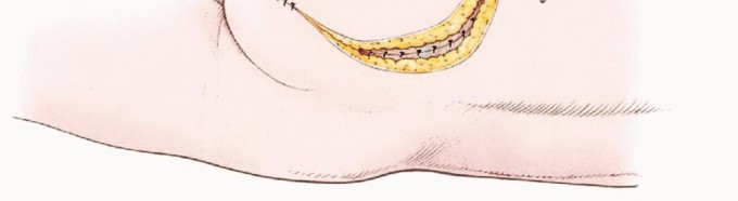Illustration 39 for Anterior Flap Hemipelvectomy: Leveraging fig tech fig for Difficult Tumors