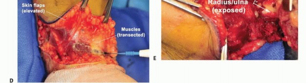 Illustration 20 for Above-Elbow & Below-Elbow Amputations: When & Why They're Needed