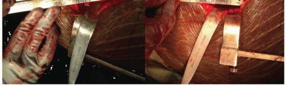 Illustration 9 for Extensively Porouscoated Stems: Proven Success & Superior Fixation