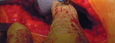 Illustration 20 for Unlock better THA: The technique of short stem for less invasiveness