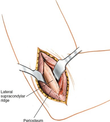 Illustration 78 for Mastering the Approach to the Distal Humerus: Safety & Skills
