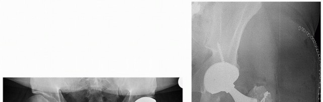 Illustration 12 for Sliding Trochanteric Osteotomy: Modern Role & Refined Techniques