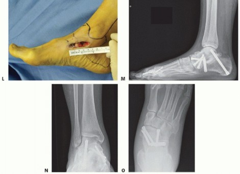 Illustration 63 for Medial Ankle Instability: Find Relief with Reconstruction