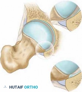 Illustration 7 for Solving Hip Soft Tissue Pathology with Advanced Arthroscopy
