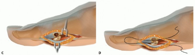 Illustration 10 for Optimizing Internal Fixation of Sesamoid Fractures