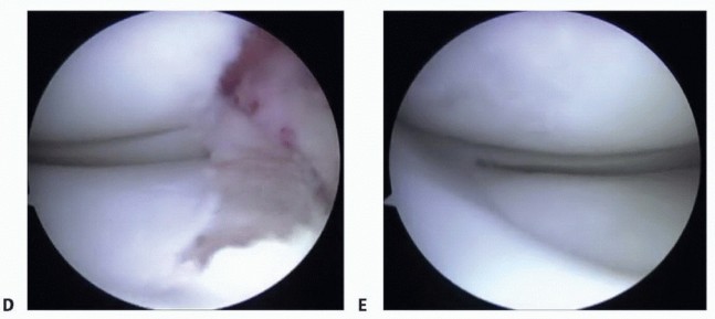 Illustration 19 for Symptomatic Knee? Meniscal Transplant for Anterior & Posterior Horns