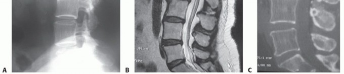 Illustration 4 for Anterior Lumbar Interbody: Fusion, Disc Replacement & Pain Relief