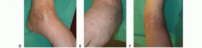 Illustration 36 for Optimize Pain Management with Proximal Ring Block for Ankle Arthrodesis