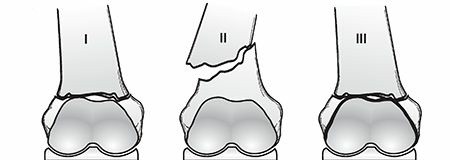 Illustration 6 for Periprosthetic Fractures: Causes, Risks, & Effective Treatment