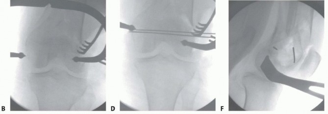 Illustration 70 for Repairing Distal Femur Fractures: Open Reduction & Internal Fixation