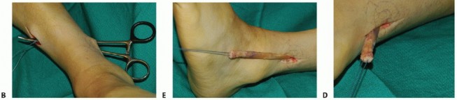 Illustration 12 for Restore Movement: Tendon Transfer for Common Peroneal Nerve Foot Drop