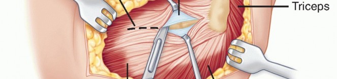 Illustration 9 for Radial Head Arthroplasty: Restoring Elbow Function & Stability
