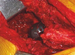 Illustration 13 for Revision THA: Acetabular Impaction Grafting for Severe Bone Loss