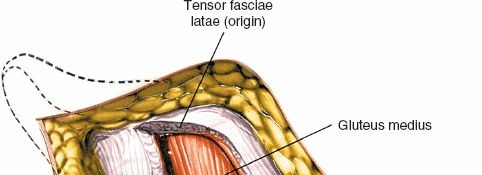 Illustration 36 for Unlocking Every Aspect of the Hip's Surgical Approaches