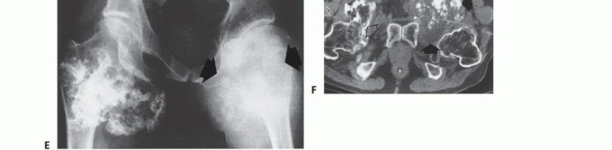 Illustration 46 for Understanding Benign Bone Tumors: Your Complete Preoperative Guide