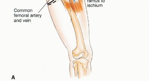 Illustration 36 for Surgical Pelvic Resection: Gluteus Maximus Muscle & Nerve Preservation