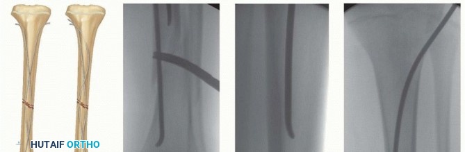 Illustration 12 for Optimal Treatment for Pediatric Tibial Fractures: Key Insights