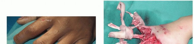 Revascularization and Replantation of the Digits