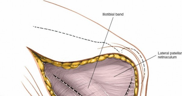 Illustration 150 for Mastering Knee Approaches: Spotlight on Superficial Medial Ligament