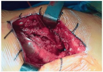 Illustration 9 for Unlock Precision: The Direct Lateral Approach for THA