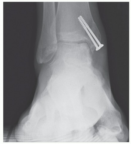 Illustration 37 for Painful Talus Lesions? The tech fig c Osteochondral Transfer Solution