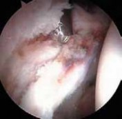 Illustration 17 for Resolving Femoral Head Neck Impingement: Arthroscopic FAI Solutions