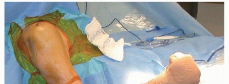 Illustration 9 for Glenoid Bone Graft for Anterior Shoulder Instability: Restore Stability