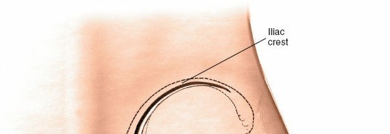 Illustration 33 for Pelvis & Acetabulum Approaches: Unlocking the Posterior Superior Iliac