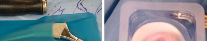 Illustration 28 for Posterolateral Surgical Approaches: Achieve Optimal Hip Replacement