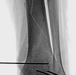 Illustration 13 for Complex Tibial Shaft Fracture: Plate Fixation for Plafond Extension