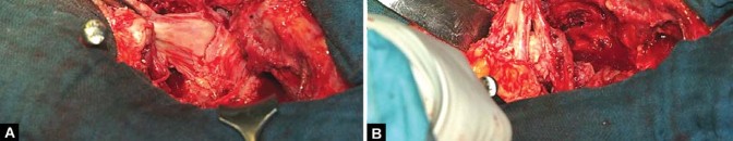 Illustration 16 for Optimizing Infected THA: The One Staged Approach Explained