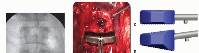 Illustration 14 for Anterior Lumbar Interbody: Fusion, Disc Replacement & Pain Relief