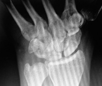 Illustration 2 for Beyond the Wrist: Why Elbow Flexion Degrees Matter for Accurate Diagnosis