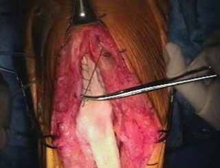 Illustration 16 for Extensor Reconstruction in Total Knee Arthroplasty: Essential Strategies